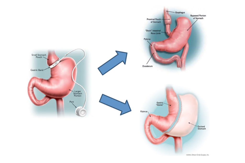 What Is Revisional Bariatric Surgery and Which Methods Are Used?