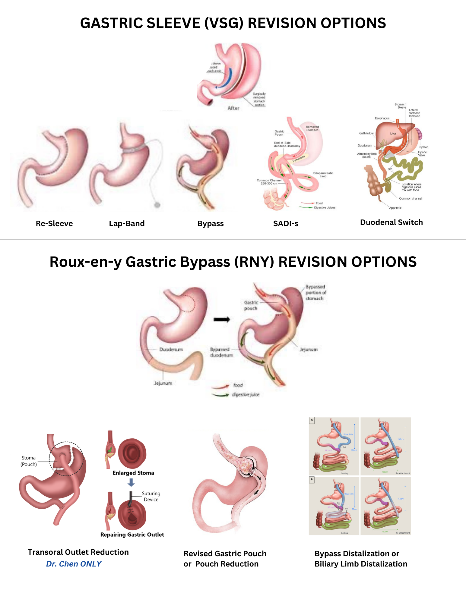 Gastric Bypass Revision
